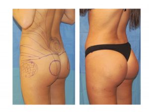 Brazilian Butt Lift vs. Buttock Implants: Which Procedure is Right for You?