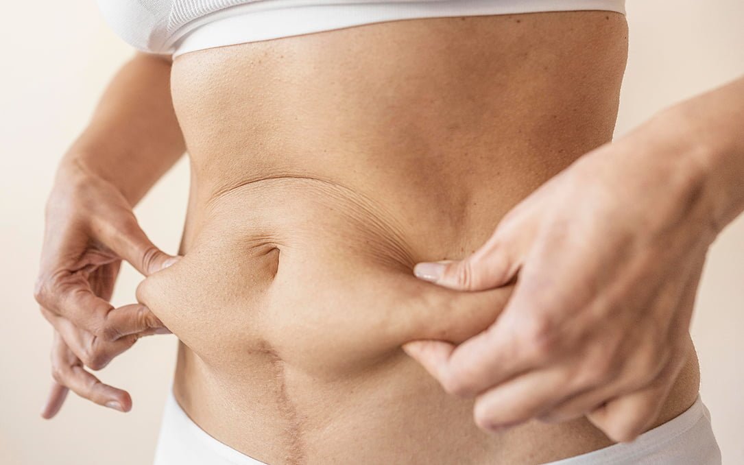 Can a Tummy Tuck Eliminate Stretch Marks? Discover the Truth!