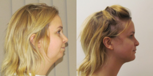 Chin Implant vs. Genioplasty: Which Facial Enhancement is Right for You?