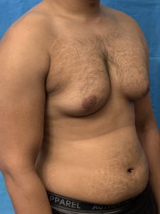 Effective Strategies for Managing Gynecomastia: A Comprehensive Guide