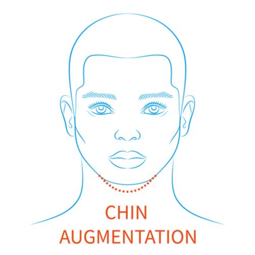 Enhance Your Masculine Features: A Comprehensive Guide to Genioplasty for Improved Facial Contours