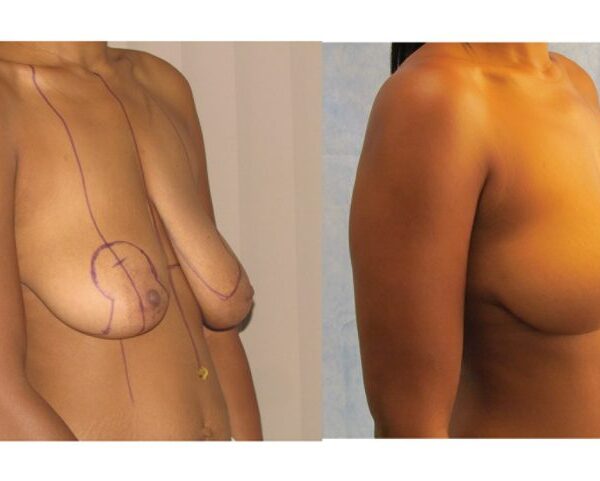 Everything You Need to Know About Breast Uplift Surgery: A Comprehensive Guide