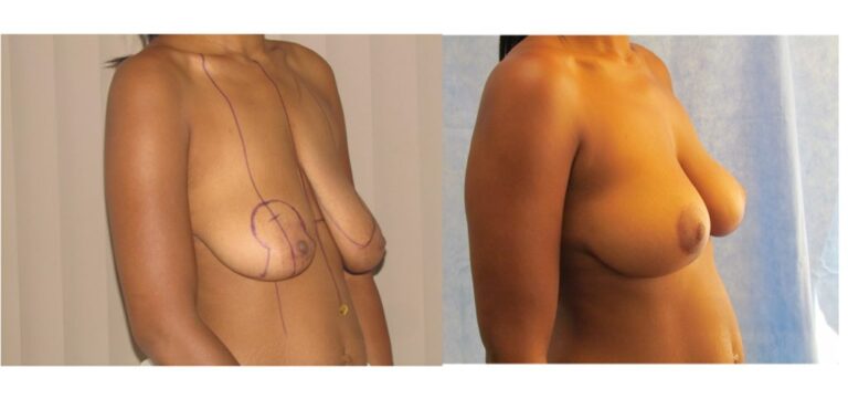 Everything You Need to Know About Breast Uplift Surgery: A Comprehensive Guide