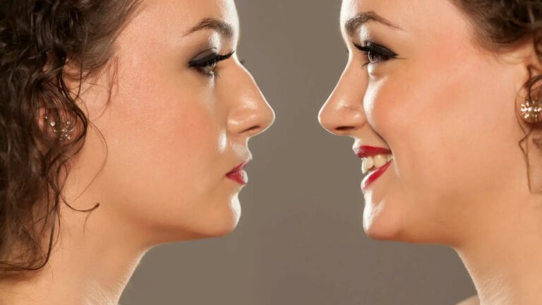 Everything You Need to Know About Rhinoplasty: Transform Your Nose with Expert Insights!