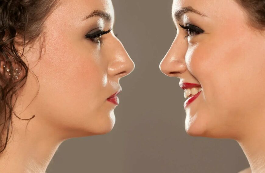 Everything You Need to Know About Rhinoplasty: Transform Your Nose with Expert Insights!