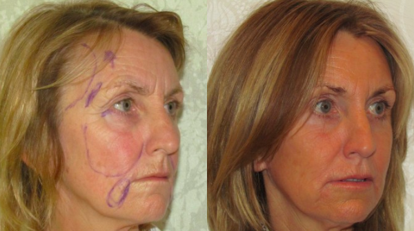 Facelift Scars Explained: Essential Insights for a Smooth Recovery