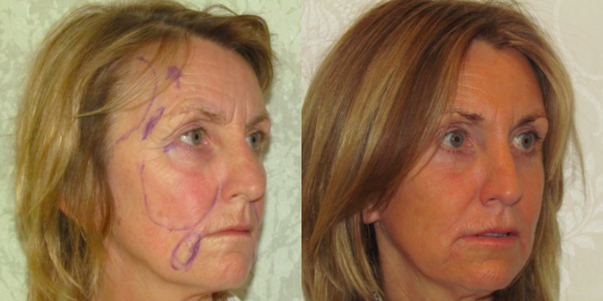 Facelift Scars Explained: Essential Insights for a Smooth Recovery