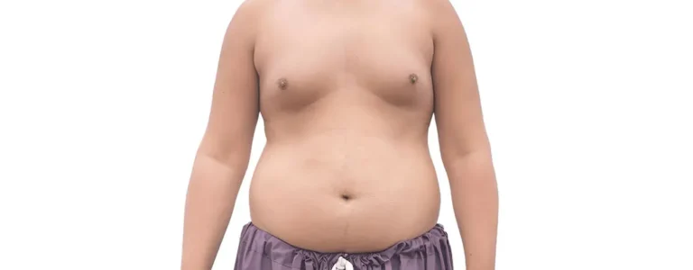 Identifying Gynecomastia: Key Signs and Symptoms You Shouldn't Ignore