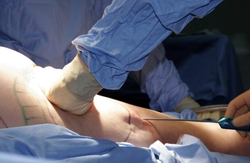 Liposuction Unveiled: Essential Insights on Its Benefits and Limitations