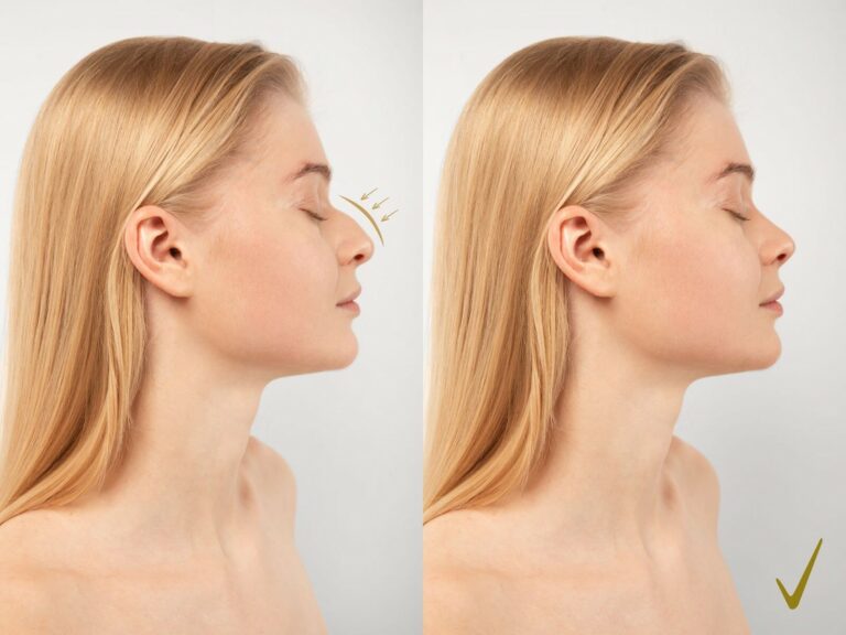 Navigating Your Nostril Surgery Journey: Essential Insights and What to Expect