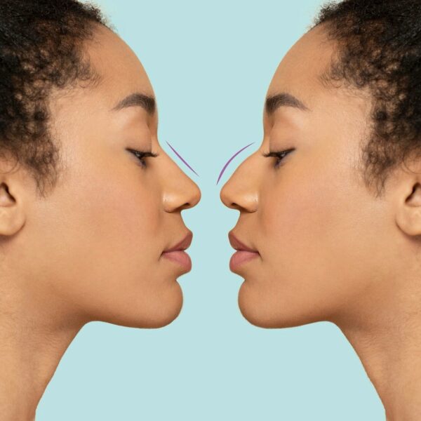 Rhinoplasty vs. Septoplasty: Discover the Perfect Nose Makeover for You!