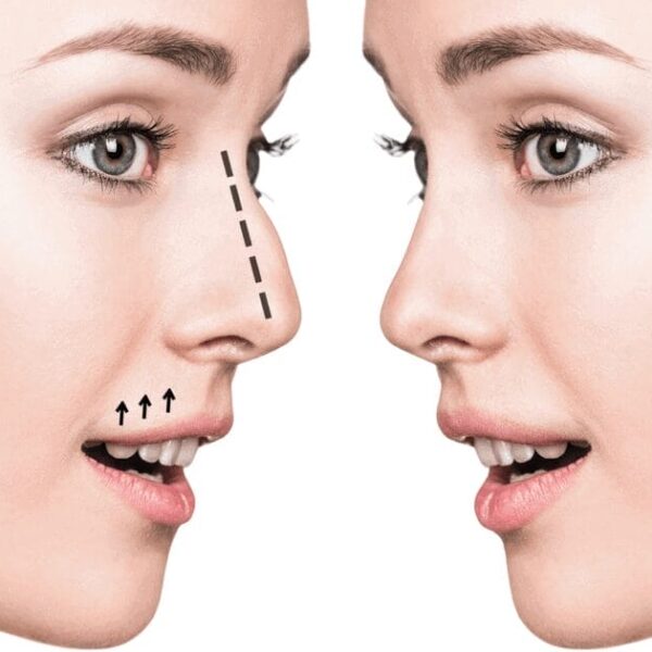 Spotting Rhinoplasty: 7 Tell-Tale Signs Someone's Had a Nose Job