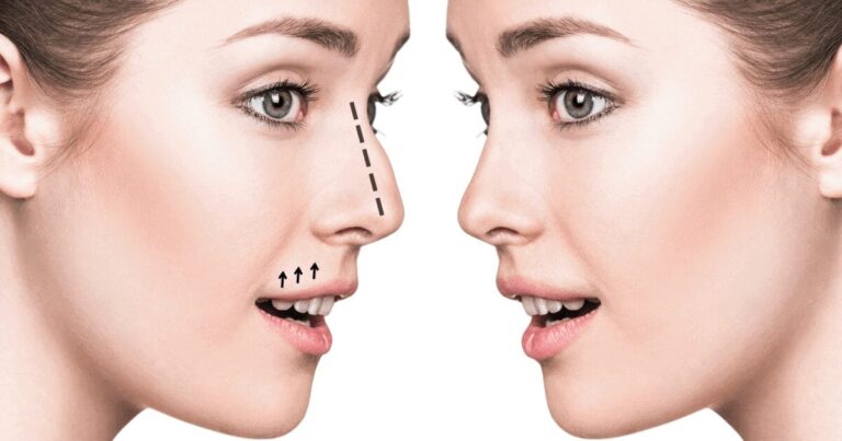 Spotting Rhinoplasty: 7 Tell-Tale Signs Someone's Had a Nose Job