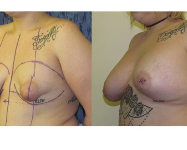 Transform Your Confidence: A Comprehensive Guide to Overcoming Tuberous Breast Deformity