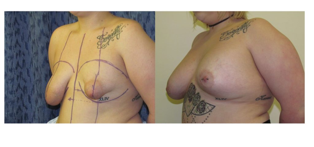 Transform Your Confidence: A Comprehensive Guide to Overcoming Tuberous Breast Deformity