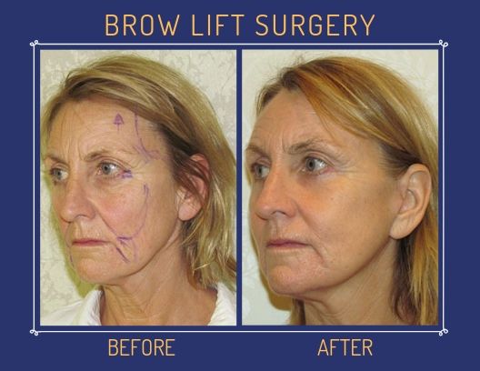 Transform Your Look: Discover the Benefits of Brow Lift Surgery for a Youthful Appearance