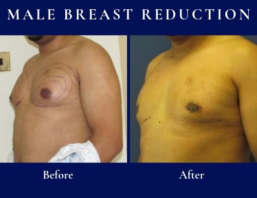 Ultimate Gynaecomastia Guide: Effective Solutions to Eliminate Male Breast Tissue