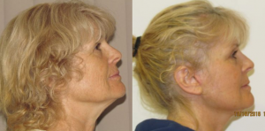 Unlocking a Youthful Appearance: The Benefits of Combining Facelift and Neck Lift Surgery