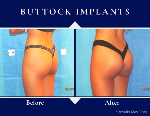 Unlocking the Secrets: How Bum Implants and Brazilian Butt Lifts Transform Your Curves!