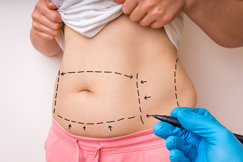 Unlocking the Timeline: When Is the Right Time for Liposuction?