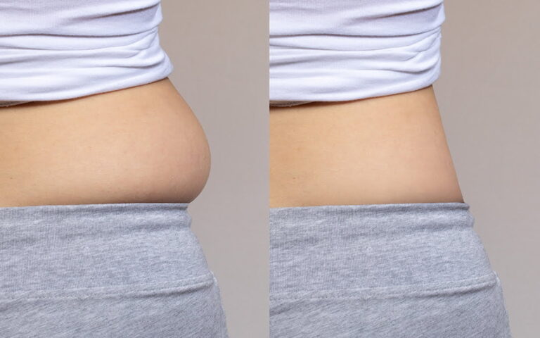 Unveiling the Truth: Do Liposuction Procedures Leave Scars? Discover the Facts!