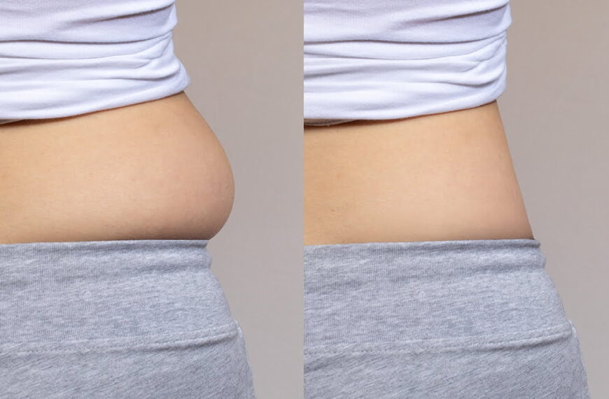 Unveiling the Truth: Do Liposuction Procedures Leave Scars? Discover the Facts!