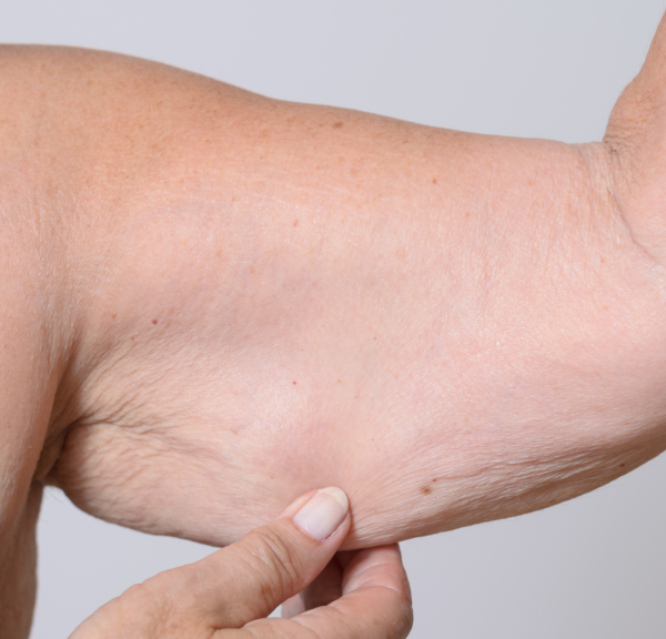 3 Compelling Reasons You Might Be the Perfect Candidate for Arm Lift Surgery