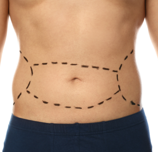 3 Compelling Reasons to Overcome Your Tummy Tuck Scar Concerns