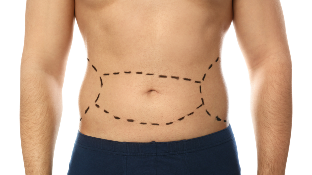 3 Compelling Reasons to Overcome Your Tummy Tuck Scar Concerns