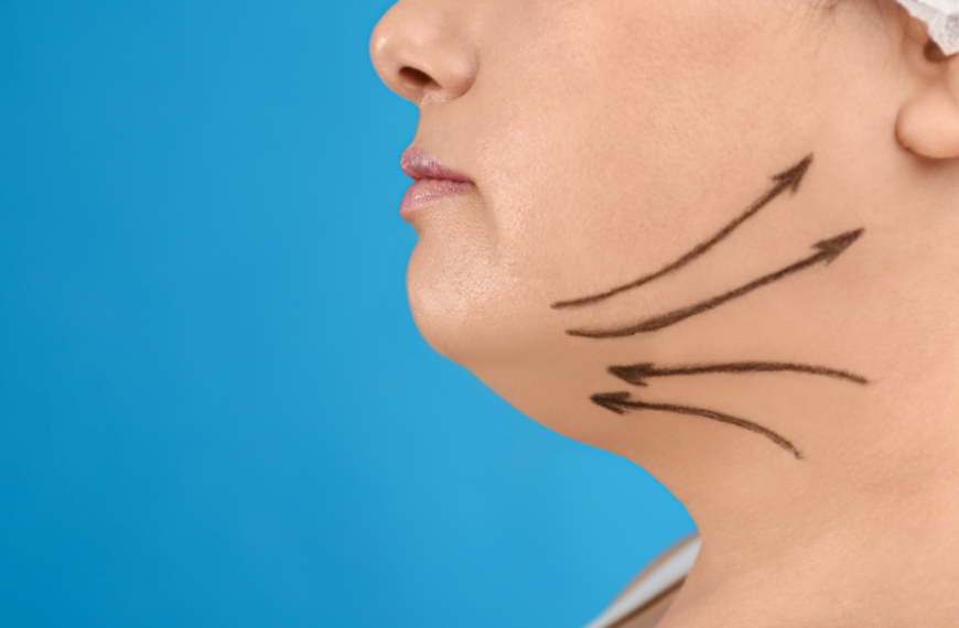Chin Liposuction vs. Fat Dissolving Injections: Discover the Best Option for a Sculpted Jawline!