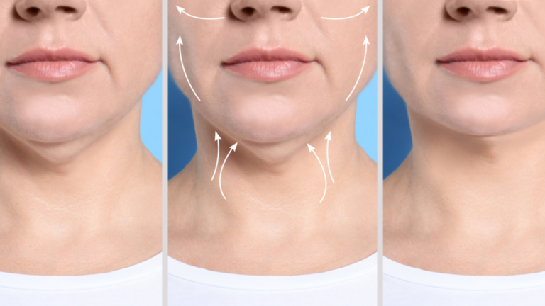 Revitalize Your Appearance: The Ultimate Mini Facelift and Neck Lift Combo for a Youthful Lower Face and Neck!