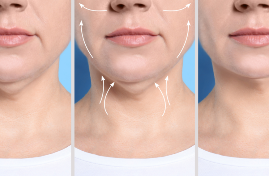 Revitalize Your Appearance: The Ultimate Mini Facelift and Neck Lift Combo for a Youthful Lower Face and Neck!