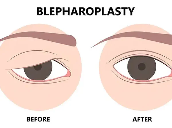 Revitalize Your Look: Discover How Eyelid Surgery Can Make You Appear More Youthful and Refreshed