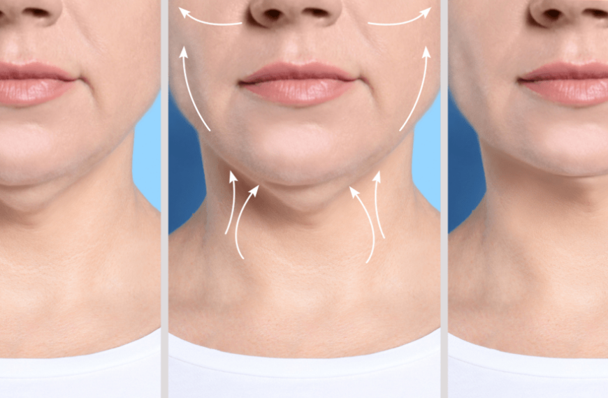 Revolutionize Your Look: Enhance Your Neck Lift with Complementary Procedures for Timeless Beauty