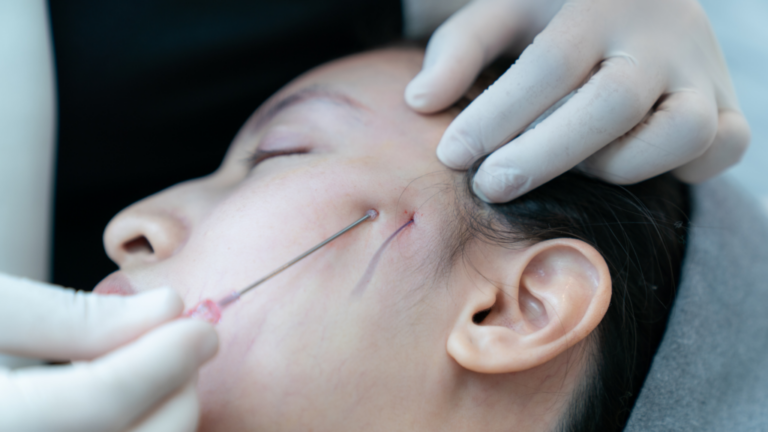 Thread Facelift: The Surprising Reasons It Falls Short of Traditional Facelift Surgery