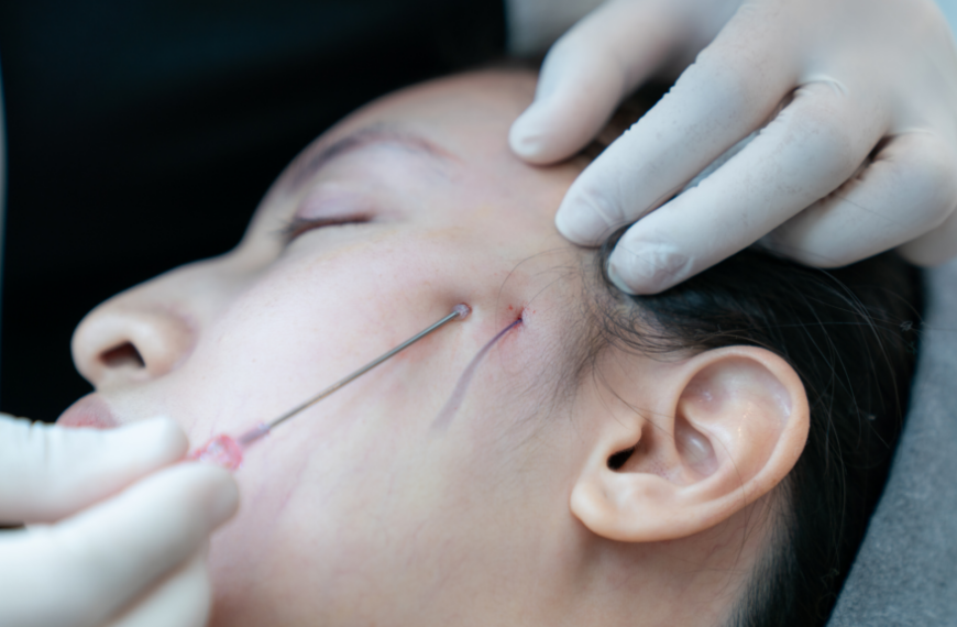 Thread Facelift: The Surprising Reasons It Falls Short of Traditional Facelift Surgery