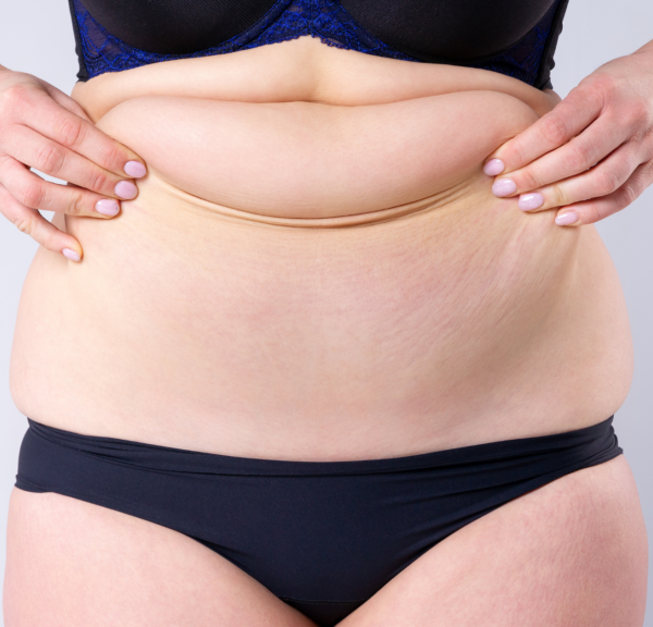 Transform Your Body: Effective Surgical Solutions for Post-Pregnancy Loose Skin in London, UK