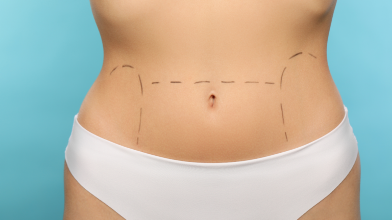 Transform Your Figure: Achieve a Sleek Stomach with a Tummy Tuck in the UK