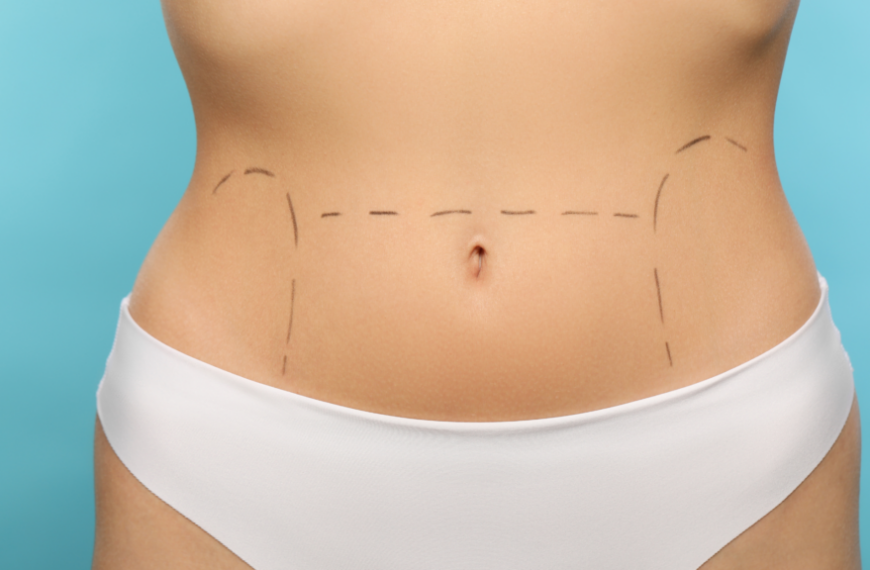 Transform Your Figure: Achieve a Sleek Stomach with a Tummy Tuck in the UK