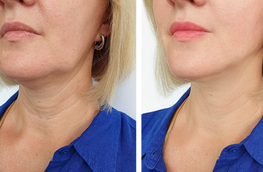 Transform Your Look: Stunning Facelift Before and After Transformations