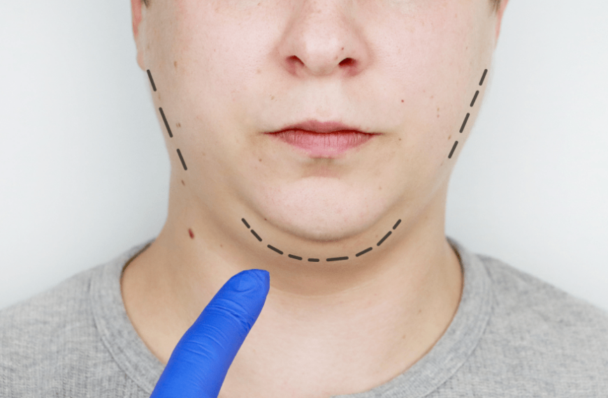 Transform Your Look: The Impact of Weight Fluctuations on Facelift Results
