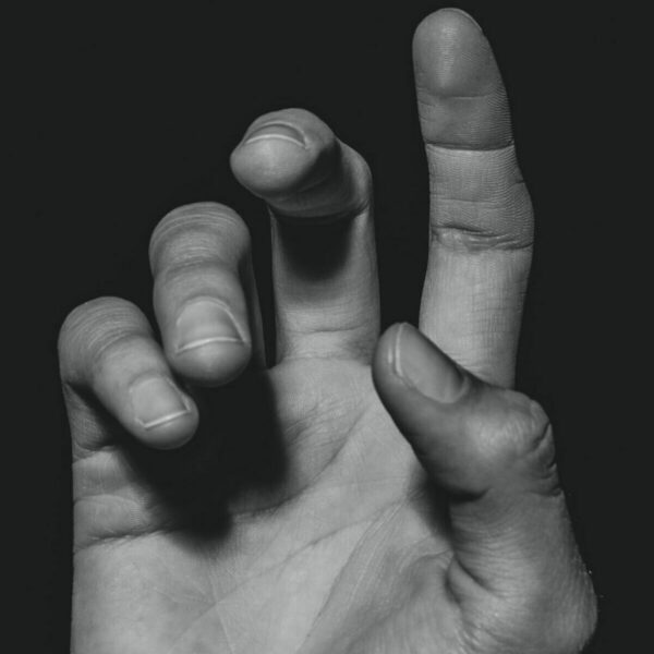 Trigger Finger vs. Dupuytren's Contracture: Key Differences You Need to Know!