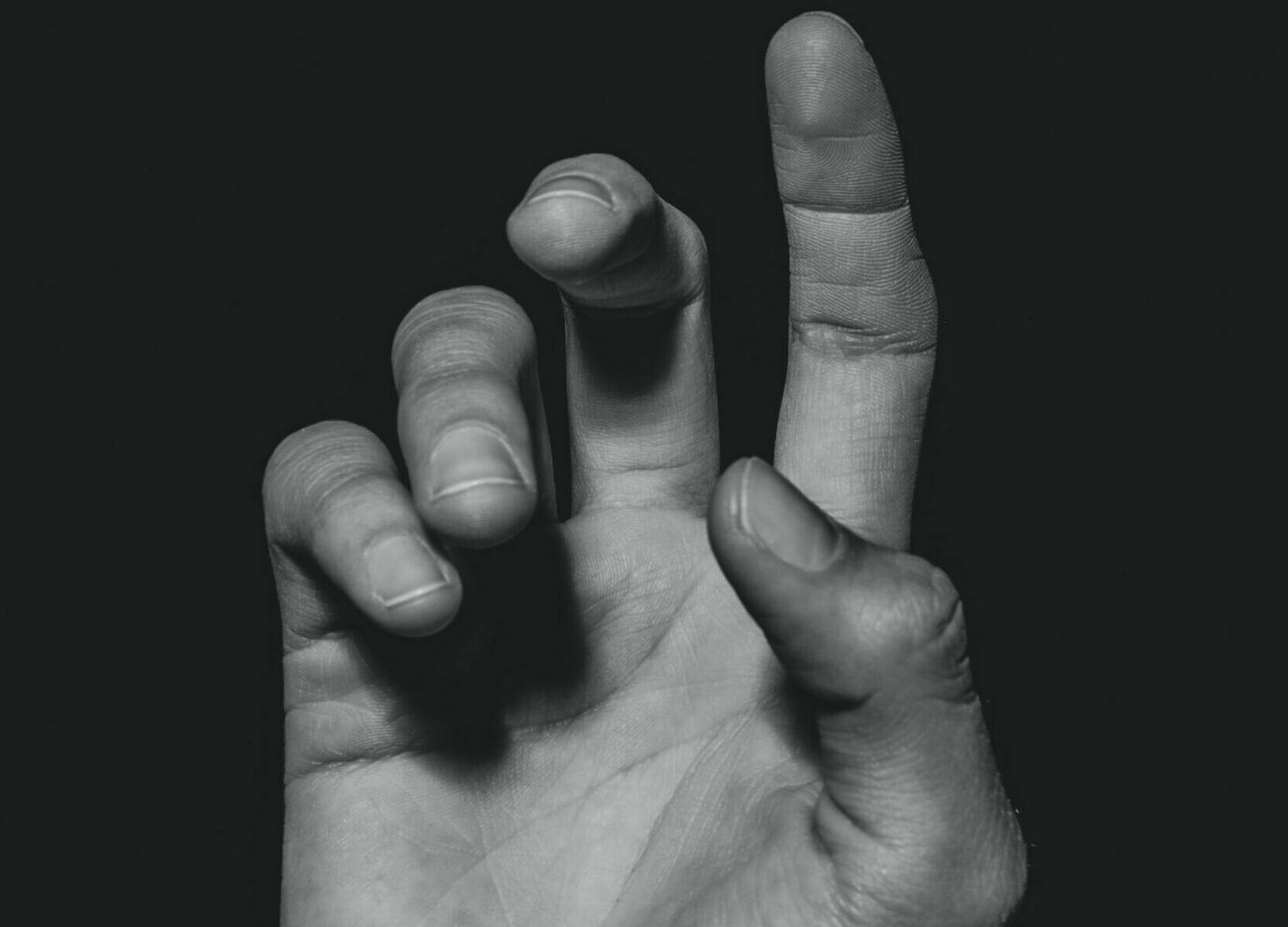 Trigger Finger vs. Dupuytren's Contracture: Key Differences You Need to Know!