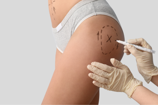 Understanding Hip Dips and Fat Transfer: Essential Insights Before Your Surgery Journey