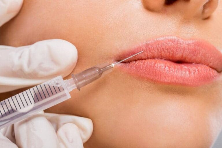 Unlock the Secrets of Lip Filler Injections: Discover Their Lasting Effects!