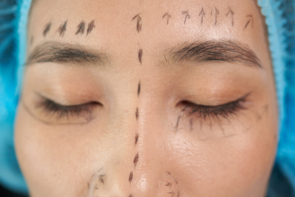 Unlocking the Secrets of Facelift Surgery: What’s Included and What to Expect!